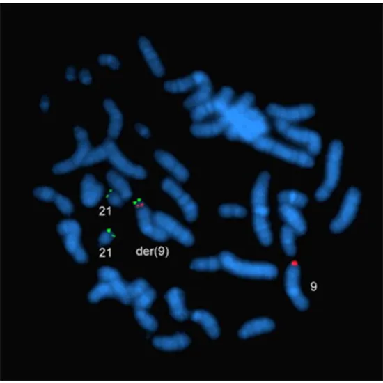 FISH, Prenatal Aneuploidy Detection-CVS (5 Probes- Trisomy 21,18,13; X,Y)
